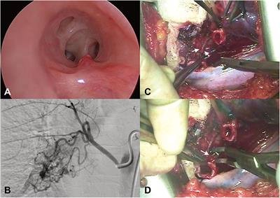 Frontiers | Bronchial Dieulafoy's Disease in Children: A Case Report